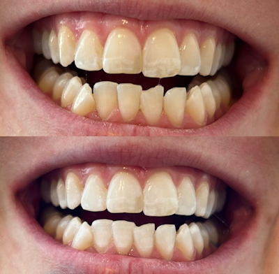 Pearly White | Plastic Surgeon in Okotoks | ProSculptMD.com